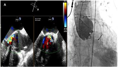 Case Report: Challenging Treatment of an AorticParavalvular Leak: How We Avoided Interference With Mechanical Valve Function?